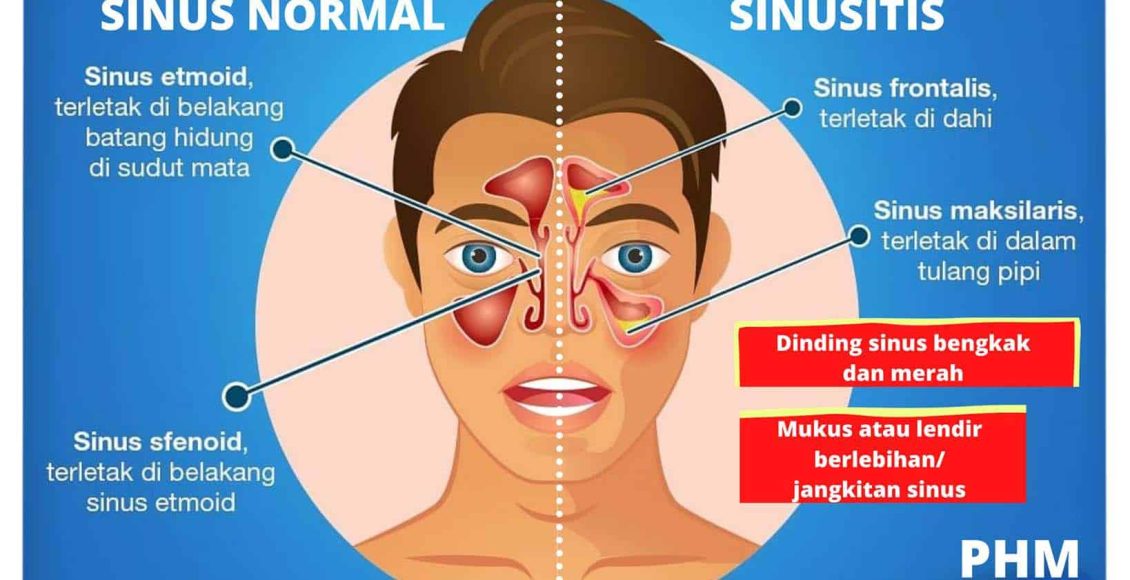 petua hilangkan resdung copy